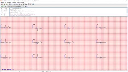 Программный модуль ЭКГ нагрузки «Stress-12-Cardio» для автоматизированного анализа ЭКГ при проведении нагрузочных проб